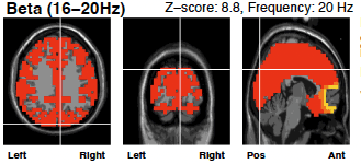 Screenshot 2024-10-28 at 3.02.45 PM beta wave brain scan before neurofeedback therapy